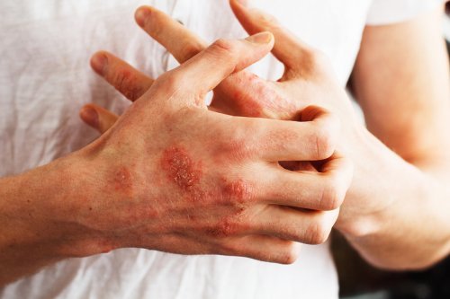 Alimentos para controlar a psoríase: recomendações