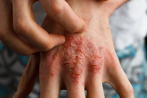 Artrite psoriatica coça
