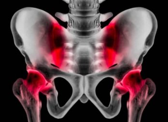 Pubalgia: causas, sintomas e tratamento