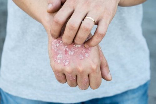 5 tratamentos tópicos para a psoríase