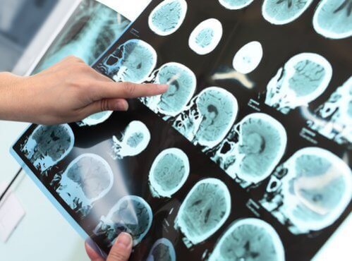 Transtorno neurocognitivo maior