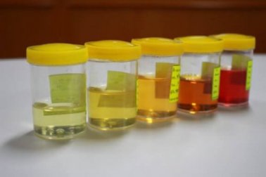 Alteração da urina: aspectos a serem considerados