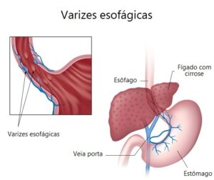 Sinais e sintomas das varizes esofágicas