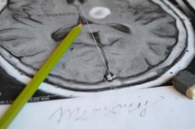 Amnésia: sintomas e prevenção