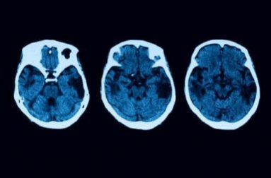 Atrofia cortical posterior: diagnóstico e tratamento