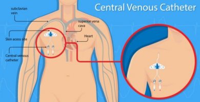 Perfuração vascular por cateter venoso central