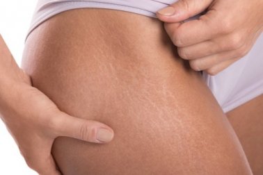 Creme caseiro com vitamina E para as estrias