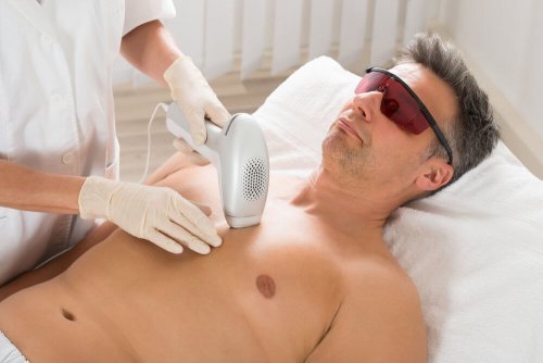 Depilação laser em homem