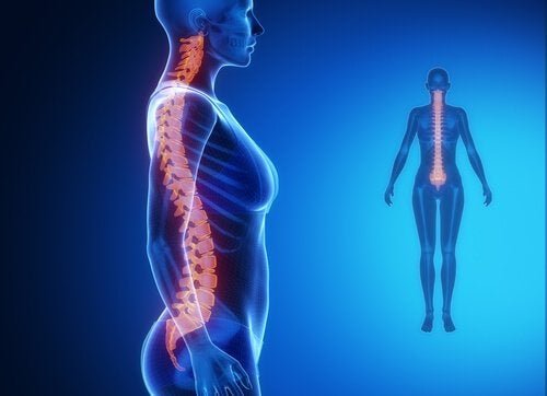 Artrose de coluna: diagnóstico e tratamento