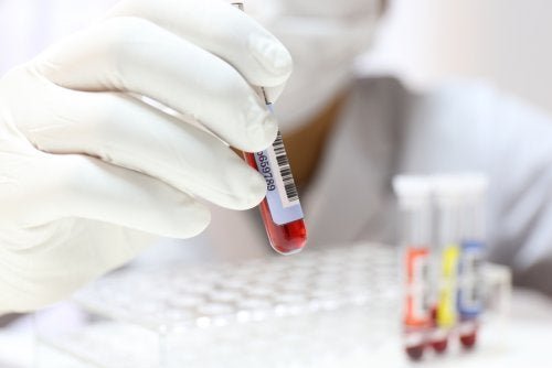 Exame de sangue para detectar hipocalcemia