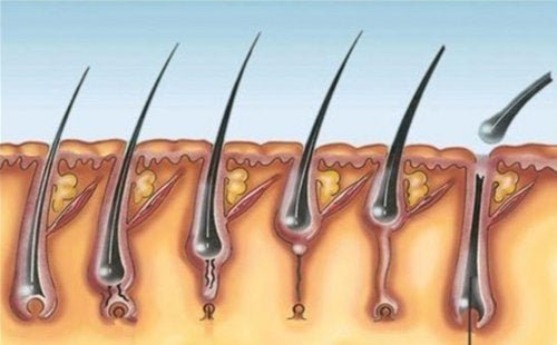 Pilomatricoma múltiplo: principais características
