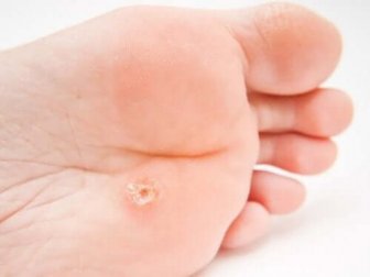 Tratamento da verruga plantar