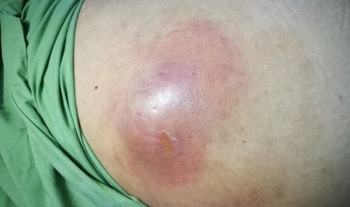 Abscessos intra-abdominais: o que são?