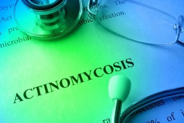 Tratamentos e prevenção de actinomicose