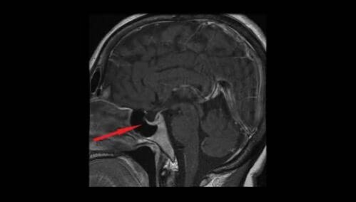 O que é adenoma hipofisário?