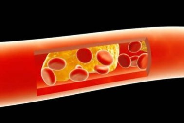 Tratamento da arteriosclerose com remédios naturais