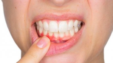 O que é e como tratar um abscesso dentário?