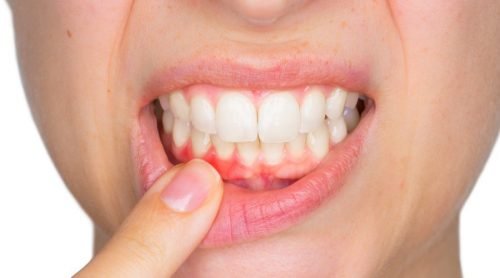 O que é e como tratar um abscesso dentário?