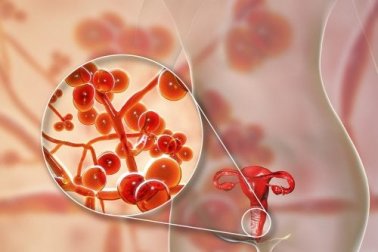 Infecção por mycoplasma genitalium: sintomas e tratamento