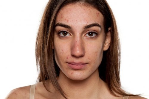 Acne em adultos