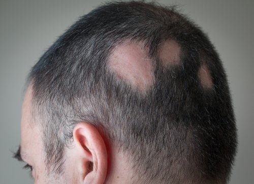 Homem com alopecia