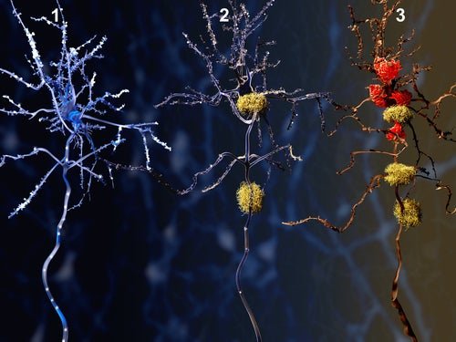 Sinapse nas fases do Alzheimer
