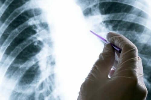 Edema pulmonar, quais os sintomas e causas?
