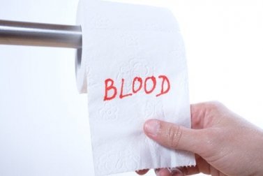 Sangue nas fezes, por que ocorre?