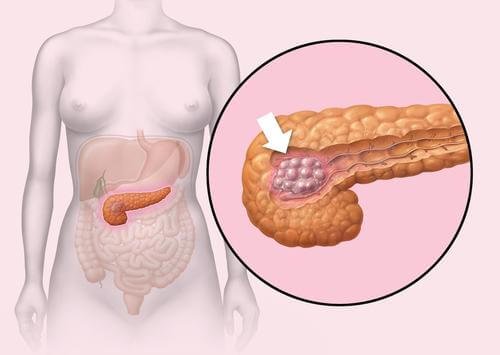 Tumor localizado no pâncreas