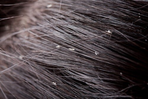 Caspa no cabelo
