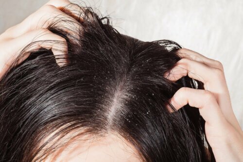 O que é a caspa no cabelo?
