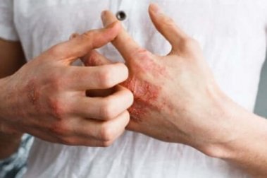 O que é dermatite atópica?