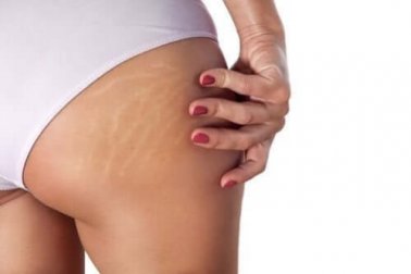 Tratamento de estrias com óleo de rícino e aloe vera