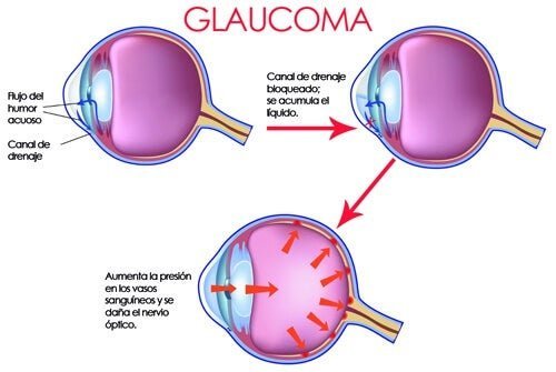Olho com glaucoma