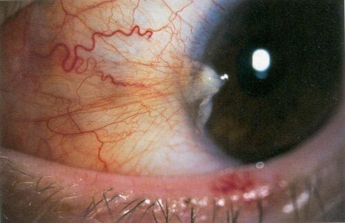Doenças oculares