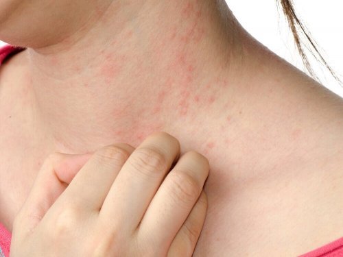 Marcas da dermatite