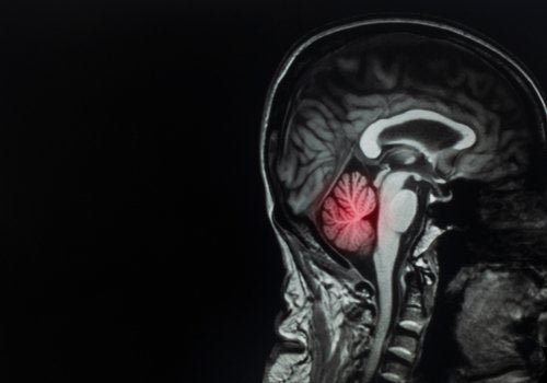Metástase cerebral: o que é e qual é o seu tratamento?