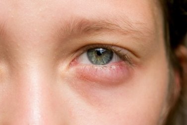 Acorda com os olhos inchados? 5 remédios rápidos!