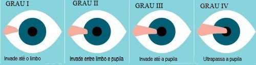 Graus de pterígio