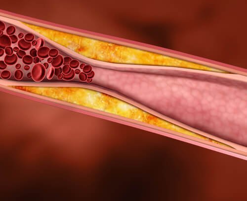 O purê de abóbora e alho combate o colesterol nas veias