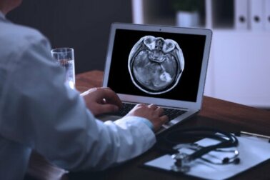 Metástase cerebral: o que é e qual é o seu tratamento?