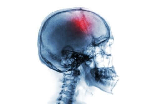 Acidente vascular cerebral (AVC): causas e tratamento