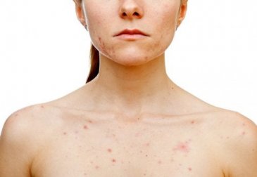 O que desencadeia acne nas mulheres?
