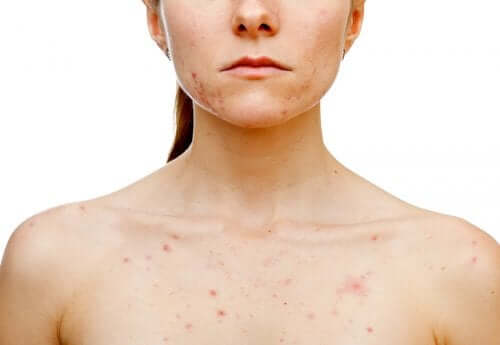O que desencadeia acne nas mulheres?