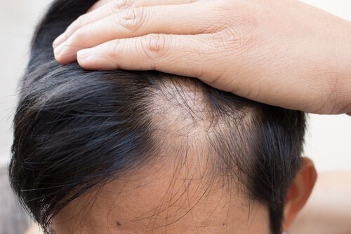 Alopecia areata, perda de cabelo