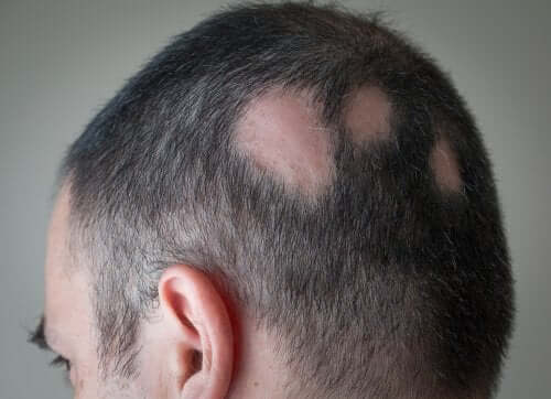 Alopecia areata: sintomas, causas e tratamentos