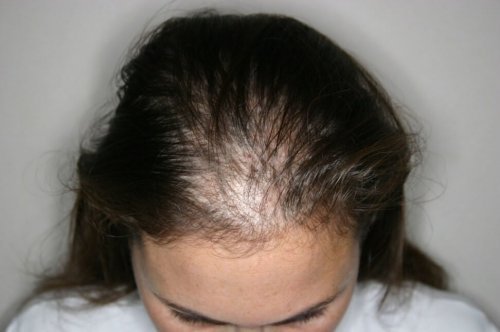 Alopecia feminina