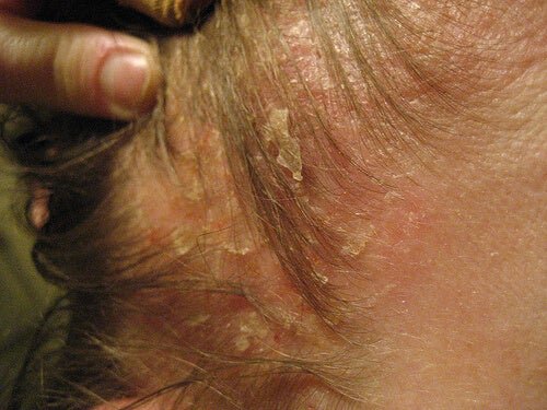 Dermatite no couro cabeludo