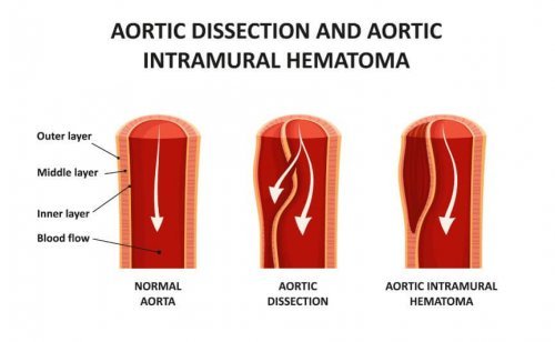 Disecção aórtica
