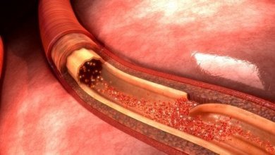 O que é uma dissecção da aorta?